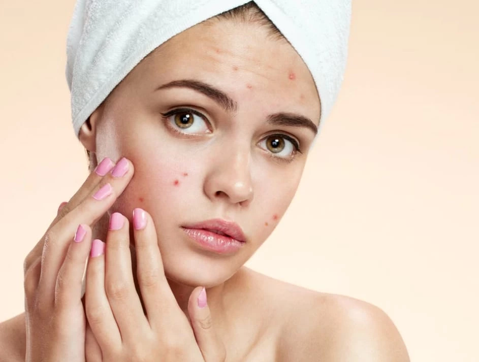 How can PDT therapy safely and effectively eliminate acne