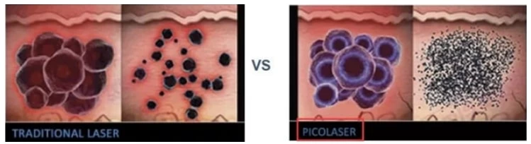 Ndyag Tatto Spot Removal Machine
