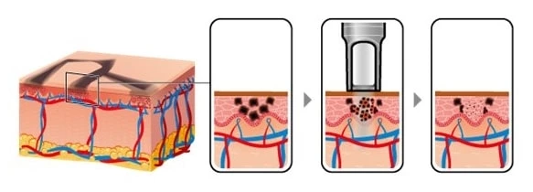 Ndyag Tatto Spot Removal Machine