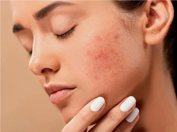 How to Cure Skin Sensitivity Damage