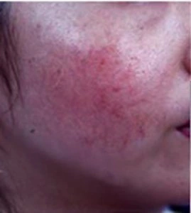 Skin Vascular Lesions and Clinical Solutions -- Redness&Facial Flushing