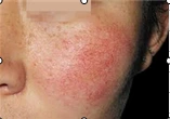 Skin Vascular Lesions and Clinical Solutions -- Redness&Facial Flushing