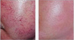 Skin Vascular Lesions and Clinical Solutions -- Redness&Facial Flushing