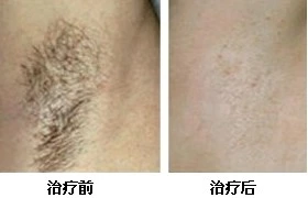 Get permanent hair removal, surprisingly painless and efficient, the secret is...