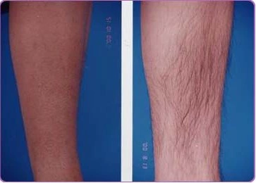 What Are the Benefits of Diode Laser Hair Removal?