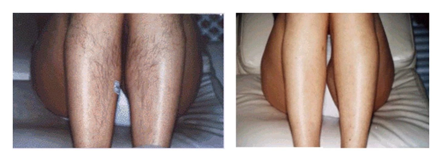 Get permanent hair removal, surprisingly painless and efficient, the secret is...