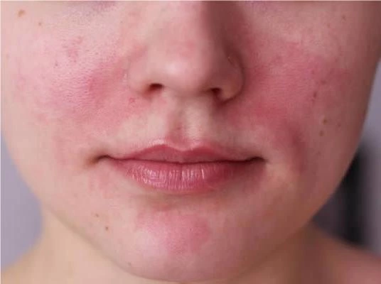 Skin Vascular Lesions and Clinical Solutions -- Redness&Facial Flushing
