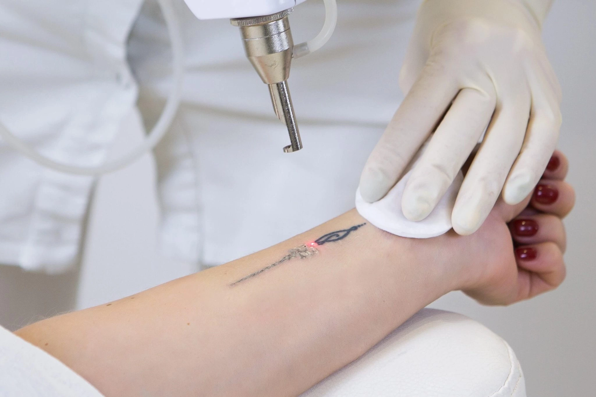 How Do ND:YAG Lasers Work in Tattoo Removal?