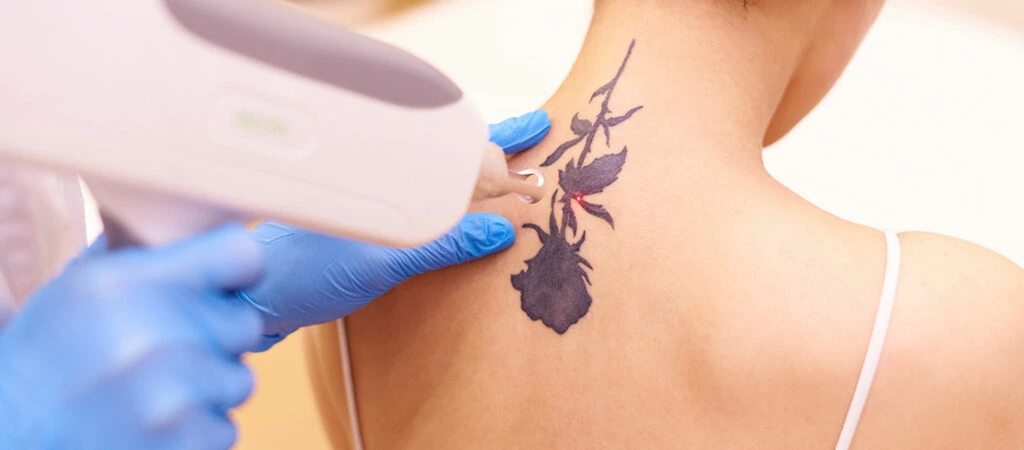 How Do ND:YAG Lasers Work in Tattoo Removal?