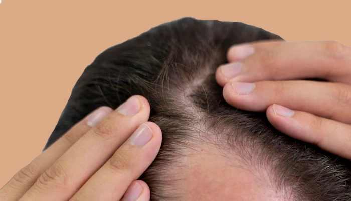 Seeking Effective Hair Loss Solutions: What Treatments Can Unlock Your Hair Growth Potential?