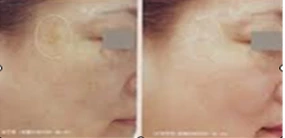 Painless Ipl Hair Removal Machine