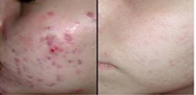 Painless Ipl Hair Removal Machine
