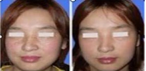Painless Ipl Hair Removal Machine