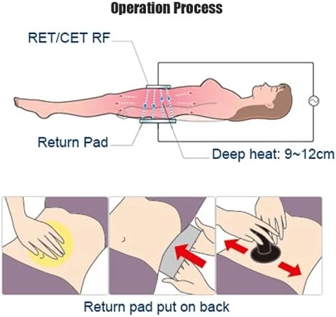 How Does RF Therapy Contribute to Optimal Body Health?