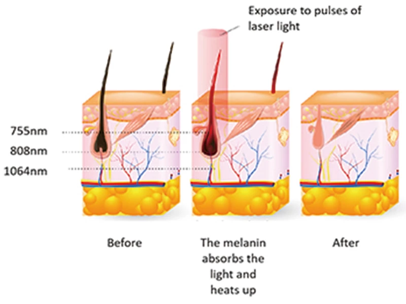 Diode Laser Hair Removal Machine