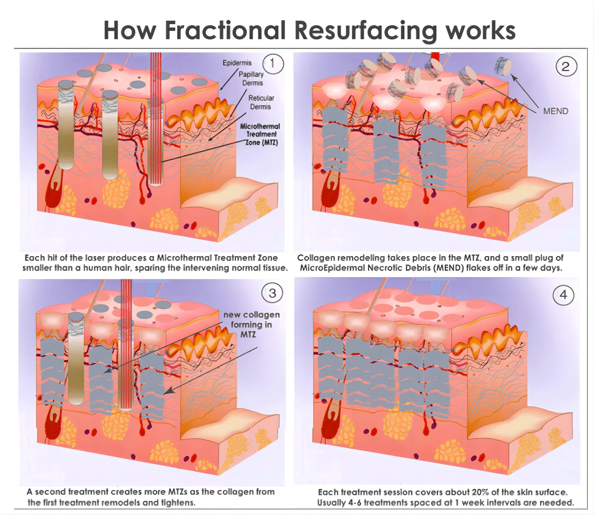 Can CO2 Lasers Be Used in Anti-Aging Treatments？