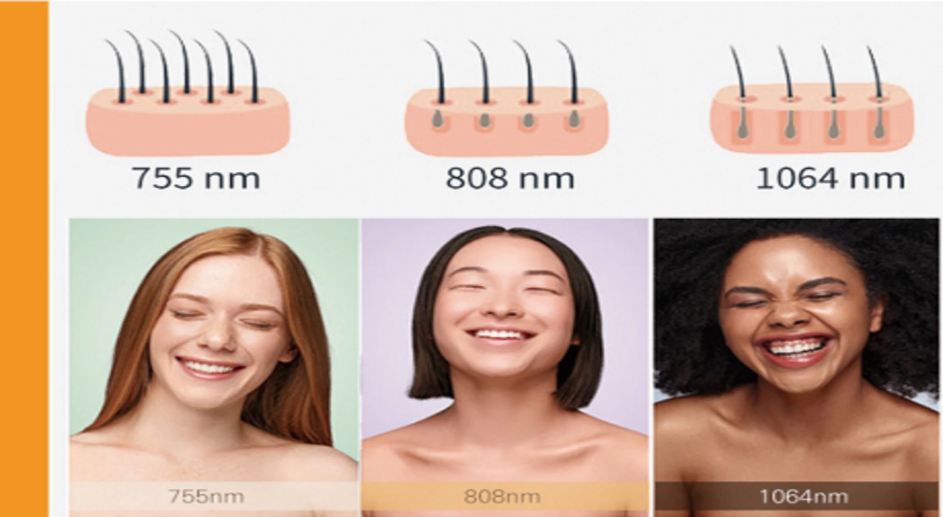 Is Laser Hair Removal Permanent ?