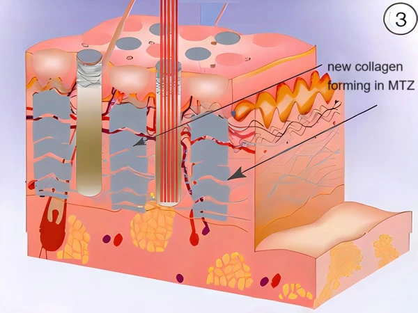 Fractional CO2 Laser Machine