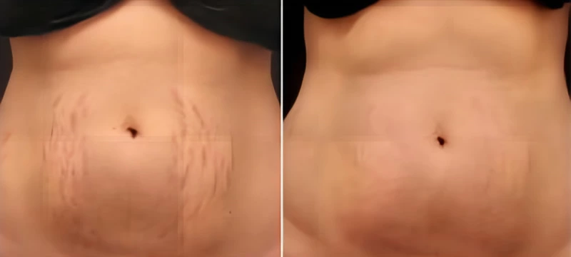 Fractional CO2 Laser Machine