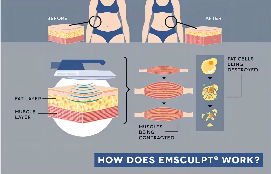 Could the EMT Muscle Building Device Be Your Key to Sculpting the Perfect Body?