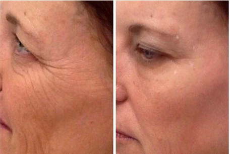 How to get rid for forehead wrinkles or vertical mouth wrinkles？