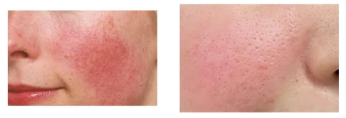 How to get rid of sunburn fast, how to treat sunburn？