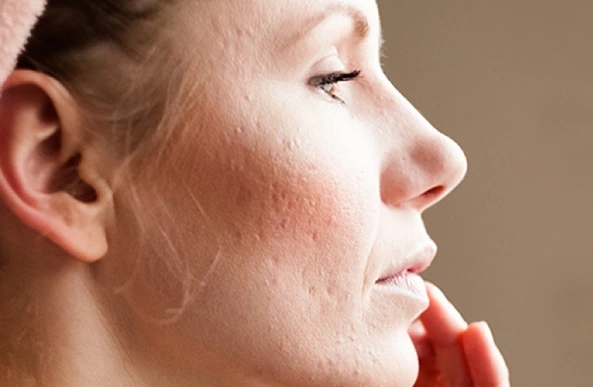 How to Repair Pimple Scars with CO2 Laser Treatment?