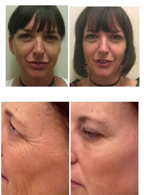 How to get rid for forehead wrinkles or vertical mouth wrinkles?