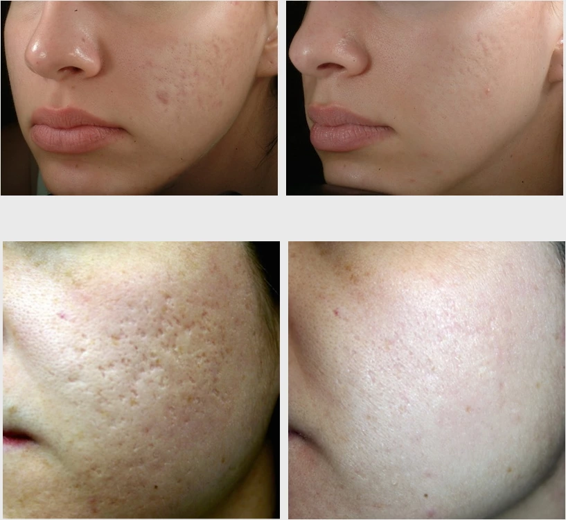 How to Repair Pimple Scars with CO2 Laser Treatment？