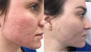 How to Repair Pimple Scars with CO2 Laser Treatment？