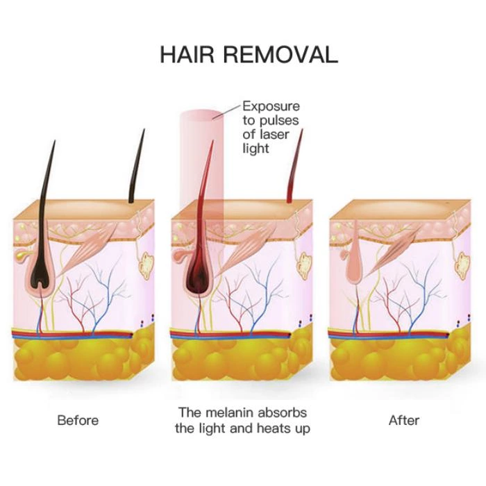 IPL laser hair removal vs. traditional laser hair removal: What's the difference?