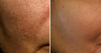 Ndyag Tatto Spot Removal Machine