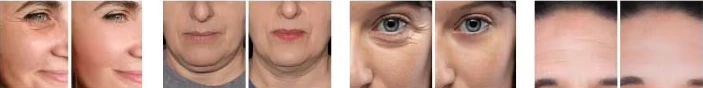 Anti-Aging Facial instrument——Multi-functional facial Anti-Aging machine