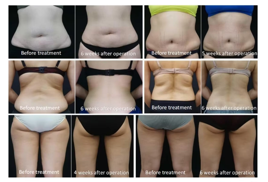 Cryo Fat Freeze Machine