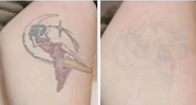 Ndyag Tatto Spot Removal Machine