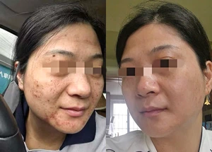 Ndyag Tatto Spot Removal Machine