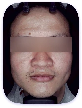 Facial Skin Analyzer Machine