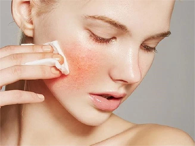 Using IPL to Treat Sensitive Skin and Redness