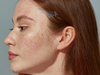 Treating Pigmentation: Laser Solutions for Melanin-Related Skin Disorders