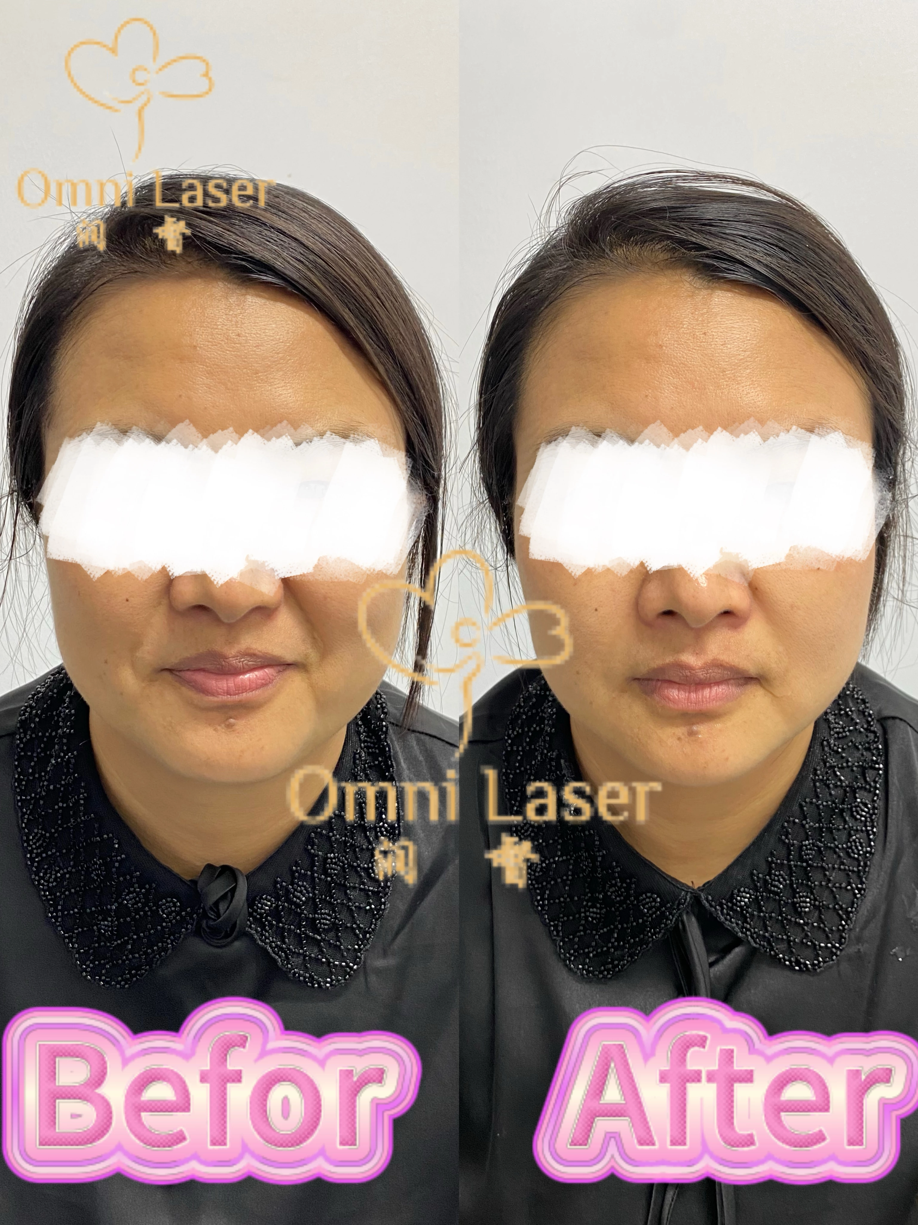 Visible Results in 1 Treatment! 3D Muscle Cyclone Face Lifting Revolution
