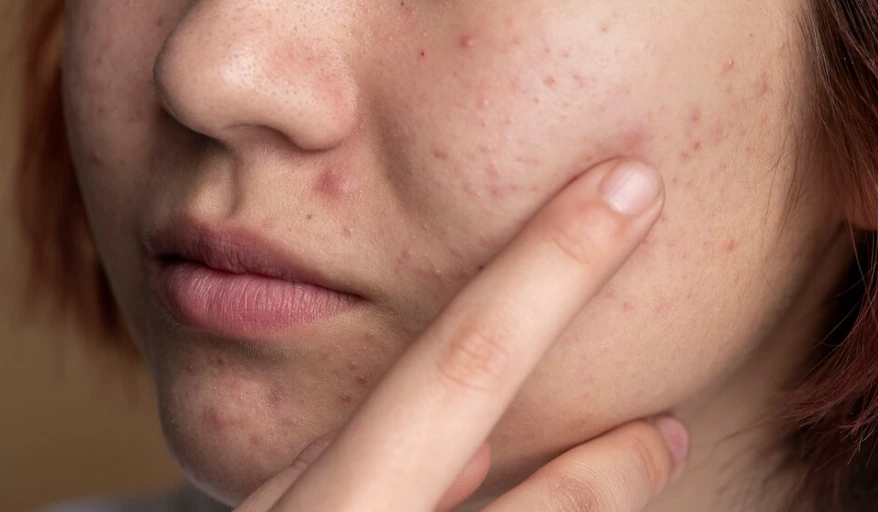 Cold Plasma (Part 1) – The Root Cause of Recurrent Acne and the Revolutionary Bactericidal Solution: How Plasma Targets Bacteria at the Source