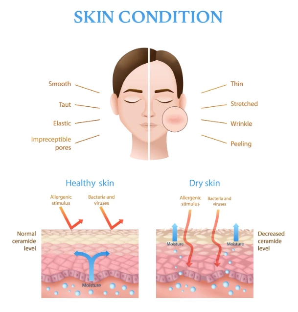 Cold Plasma (Part 1) – The Root Cause of Recurrent Acne and the Revolutionary Bactericidal Solution: How Plasma Targets Bacteria at the Source