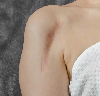 Cold Plasma (Part 1) – The Root Cause of Recurrent Acne and the Revolutionary Bactericidal Solution: How Plasma Targets Bacteria at the Source