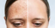 Cold Plasma (Part 6)｜Technical Summary: Why is it the Integrated Ultimate Solution for Skin Concerns?