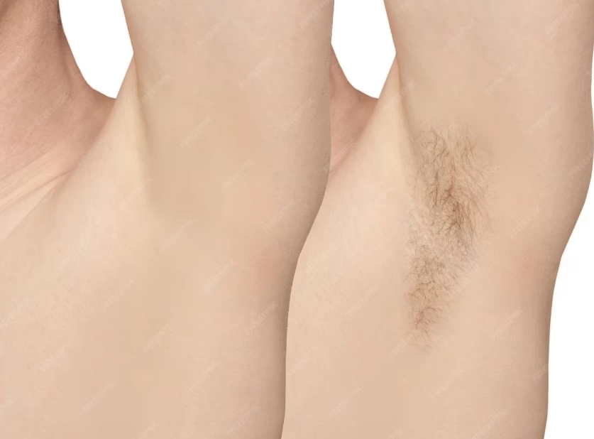 IPL (Part 2) – What Can IPL Really Do, and Why Does It Work?