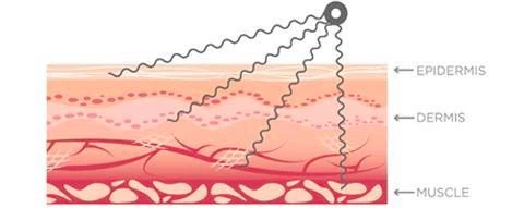 Relieve Muscle Pain and Soreness with the 3D Cyclone Wave System: Mechanism, Benefits and Science
