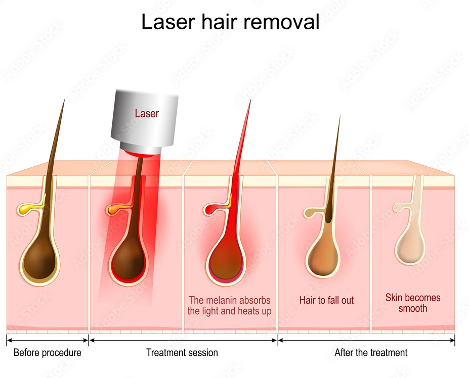 Understanding Wavelengths: Why 808nm Remains the Core of Effective Laser Hair Removal