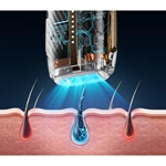 Intense Pulsed Light (IPL) Hair Removal System