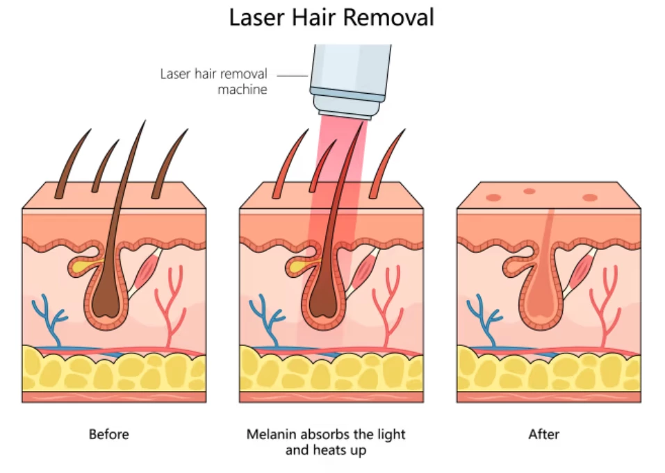 Painless Laser Hair Removal: What Makes an 808 Diode Laser Comfortable and Effective