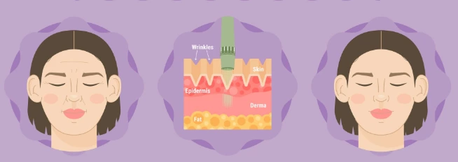 Handheld HIFU Series(Part 2) | Why Can’t Thermage and Radiofrequency Devices Replace HIFU(Ultherapy)?